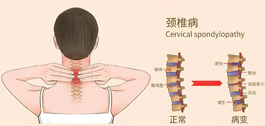 这种颈椎病可能让腿脚瘫痪，出现5个信号立即就医