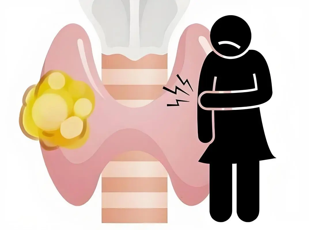 你越“懂事”，甲状腺越容易长结节？情绪才是隐藏元凶！