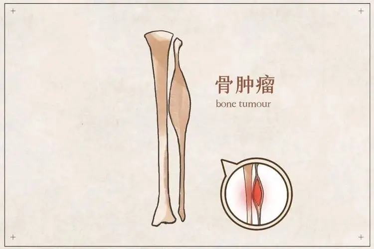  骨头也会得癌？身体出现这些“不对劲”，赶紧去查查！