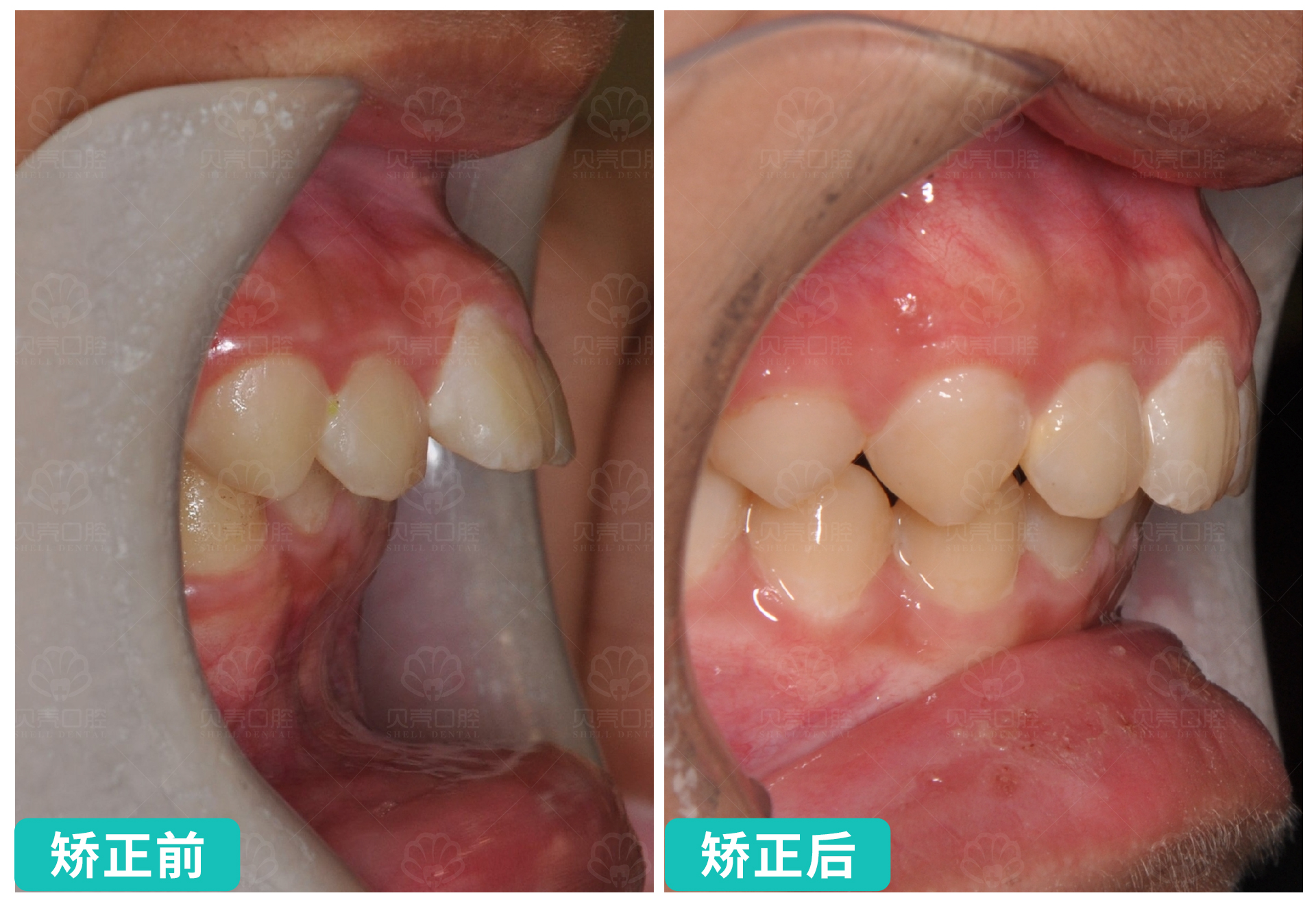 深覆合深覆盖、下颌后缩、咬合不适