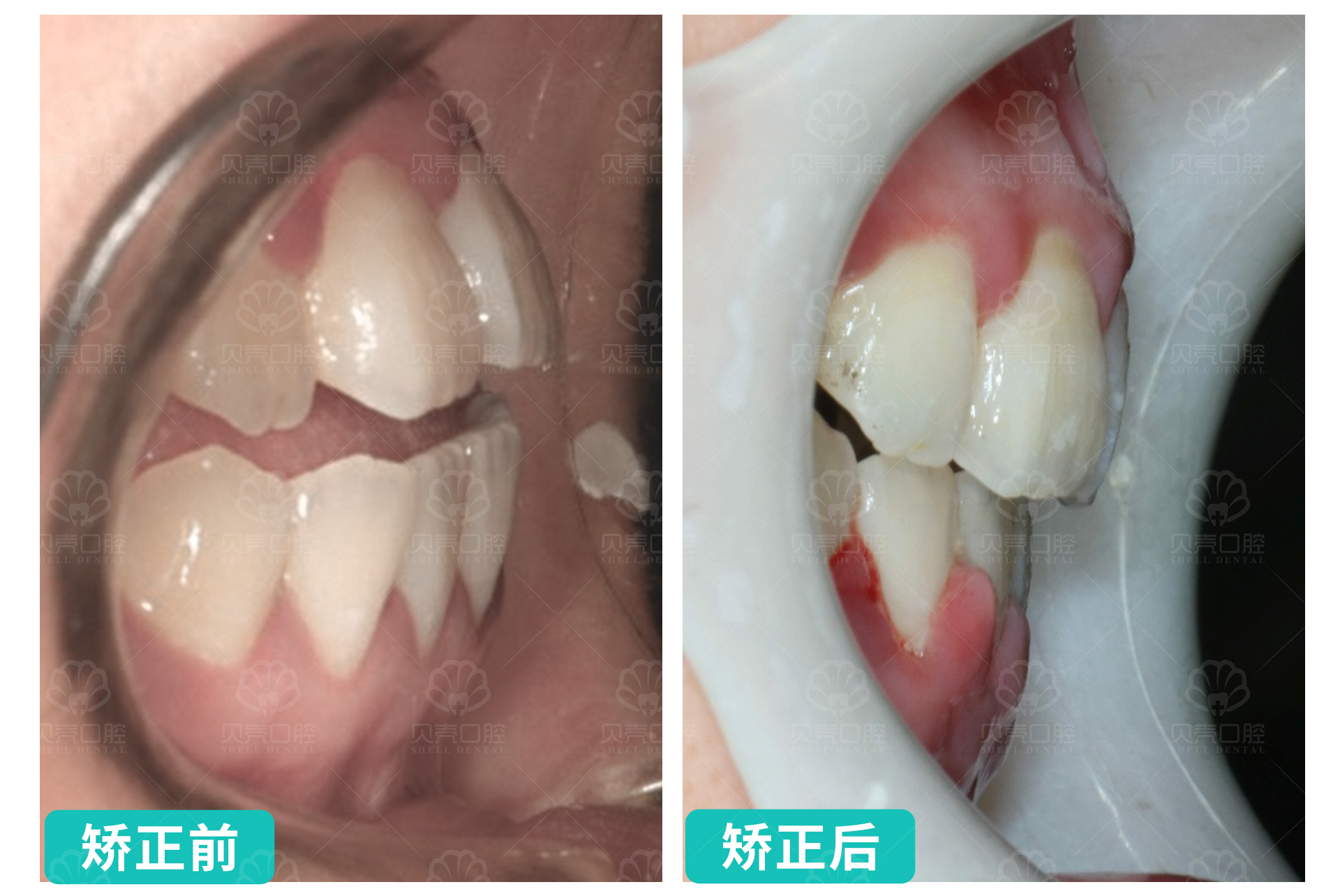 牙齿排列不齐，存在拥挤、错位等状况，咬合关系紊乱
