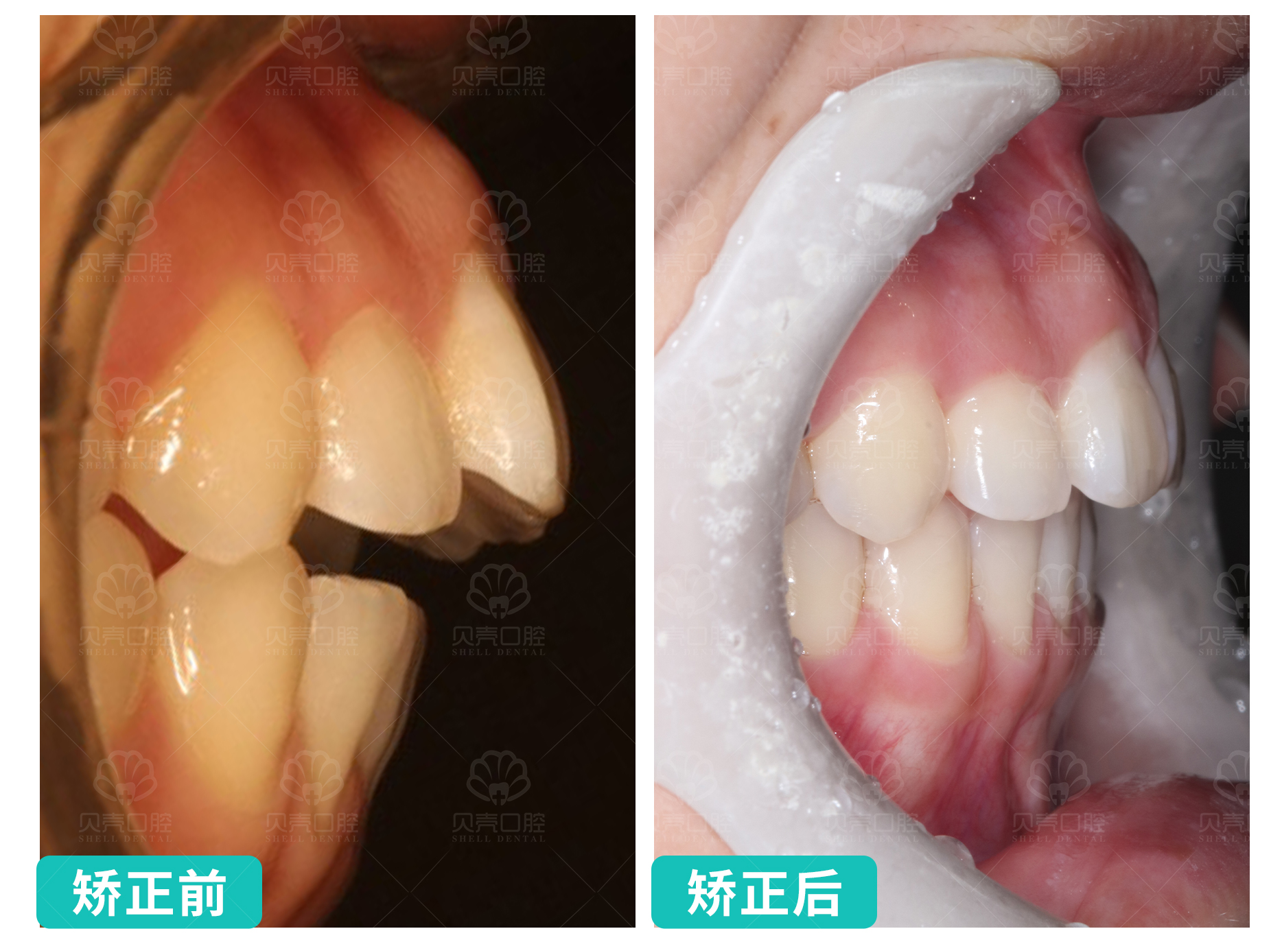 牙齿存在明显的缝隙，排列不够整齐