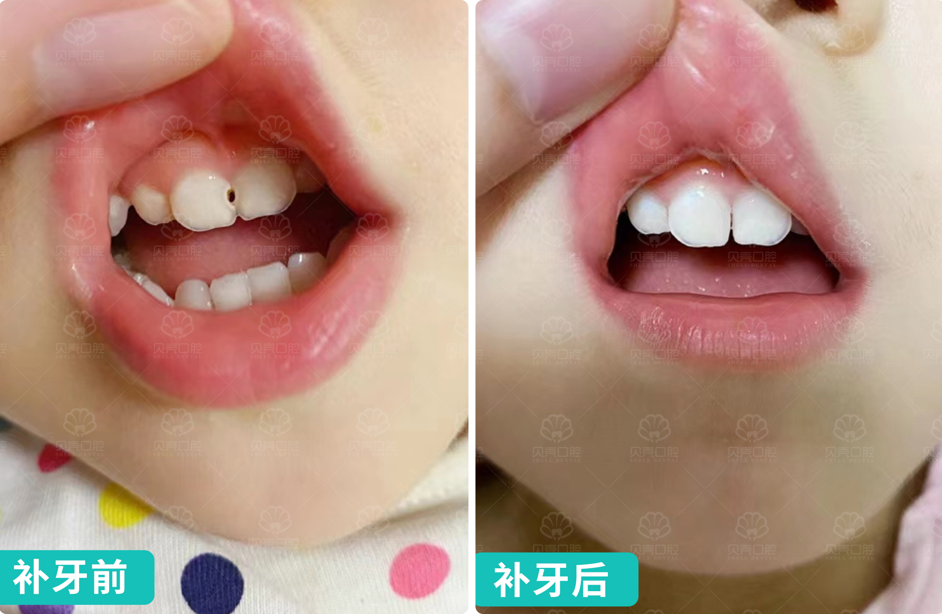 【6岁萌娃护牙记 | 乳牙蛀了别等换！👶🦷】