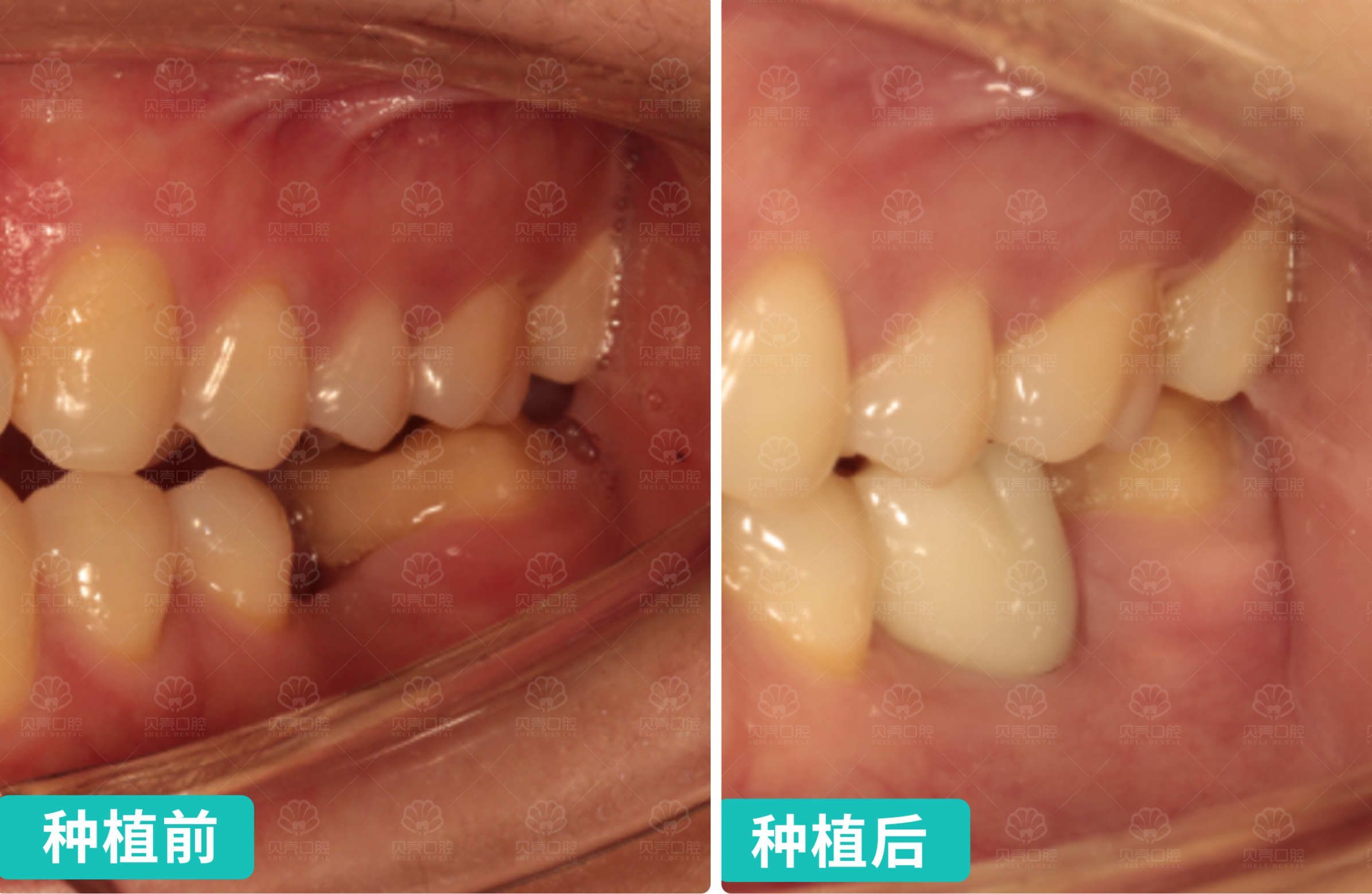 29岁，前牙单颗缺失即刻美学修复