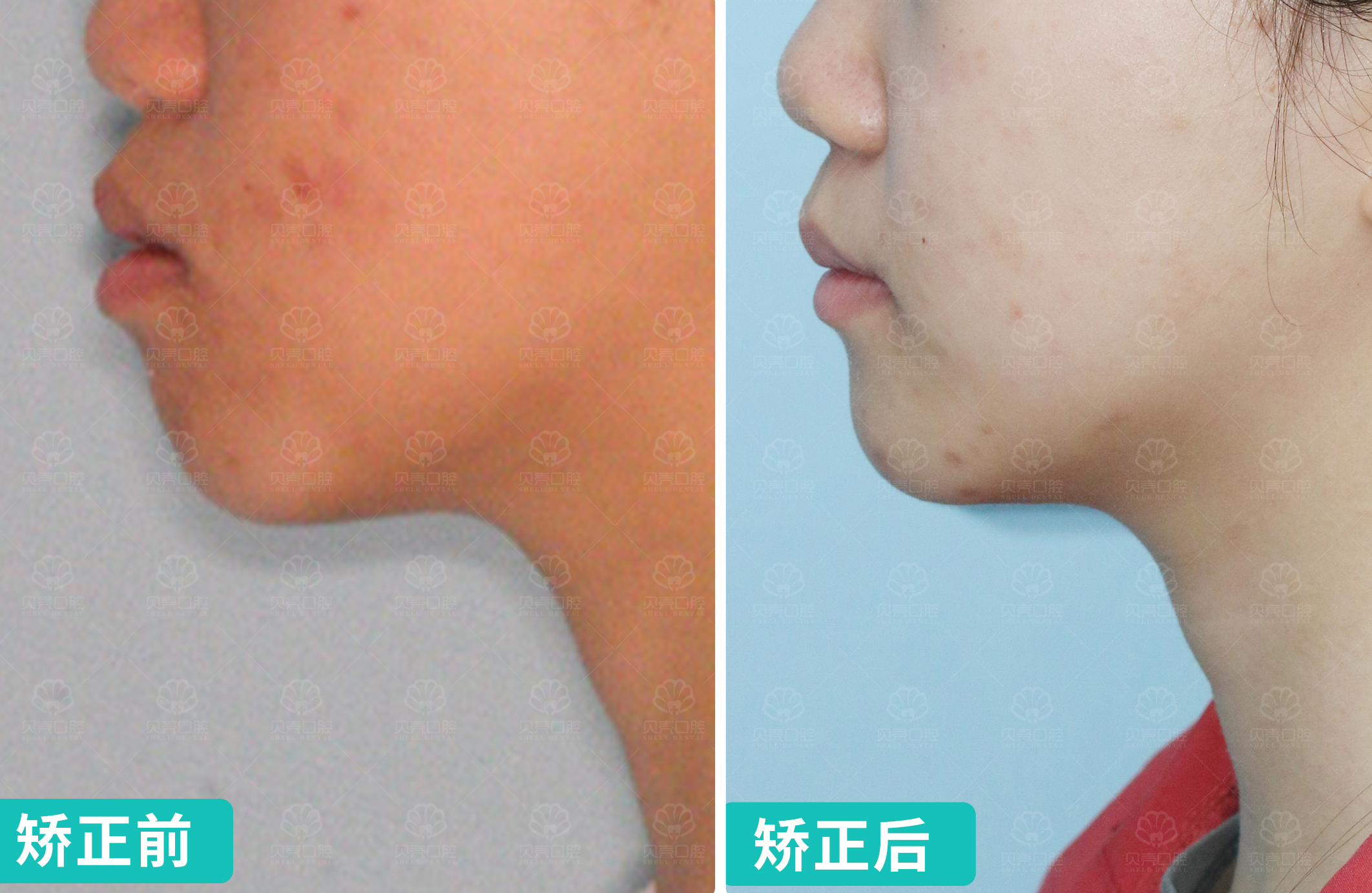 长期吐舌致前牙开颌伴嘴凸患者的功能-美学正畸诉求