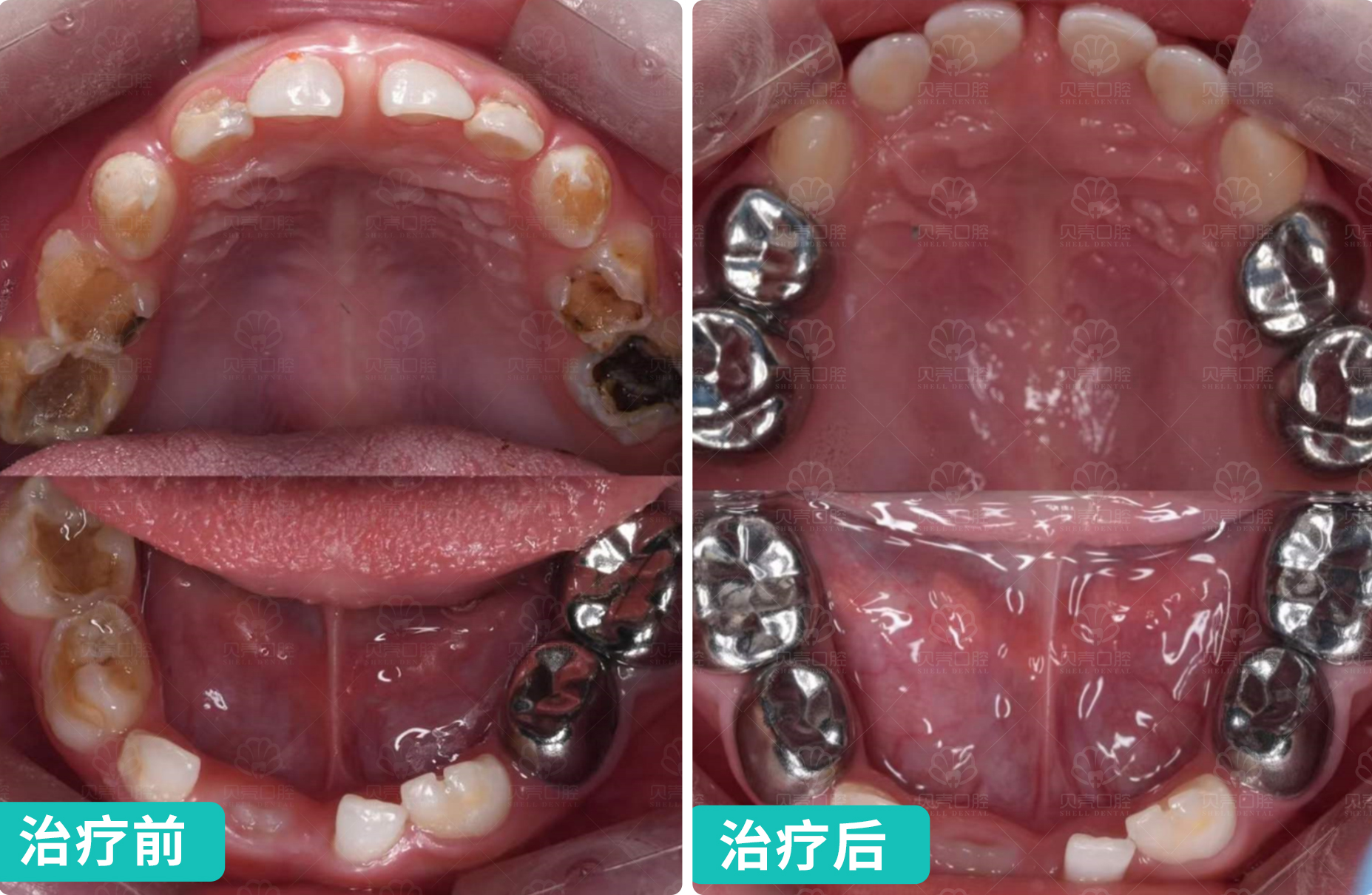 儿童预成冠修复｜快速守护乳牙健康