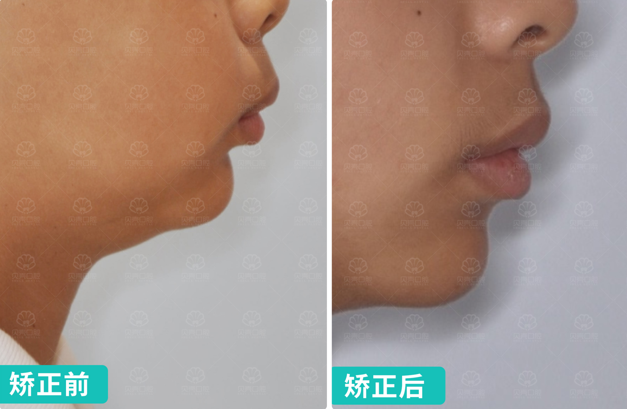 青少年男孩/深覆合深覆盖、下颌后缩、咬合不适