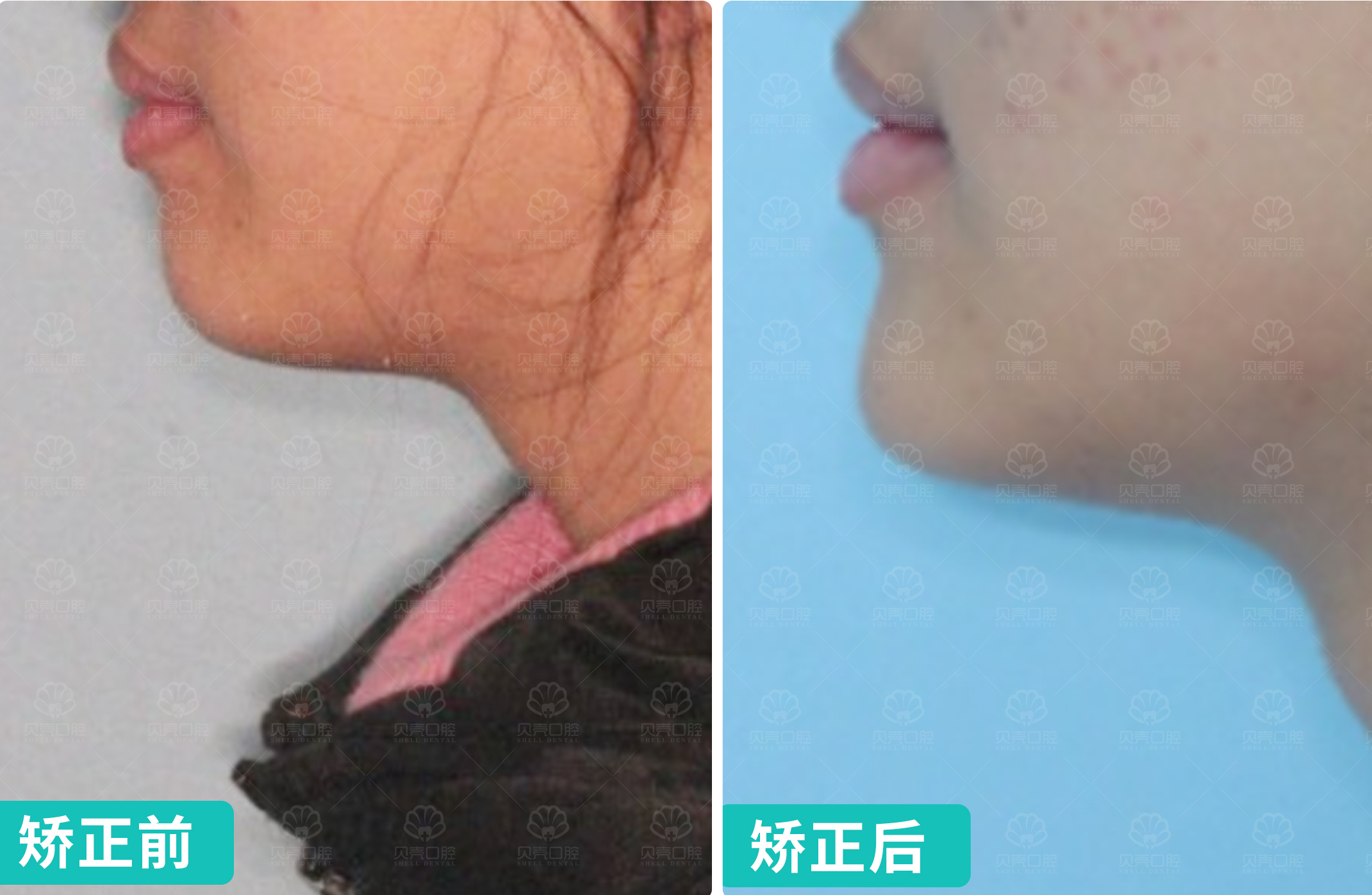 牙齿前突伴牙列不齐患者的功能-美学正畸诉求：实现自然闭唇与协调笑容