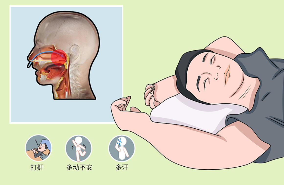 阻塞性睡眠呼吸暂停合并代谢综合征专家共识