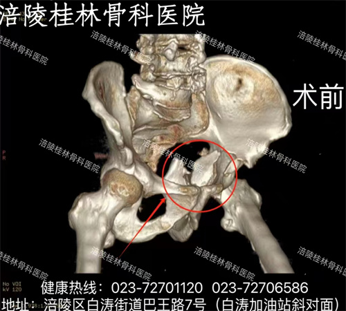 我院为79岁老人行髋臼骨折切开复位内固定术