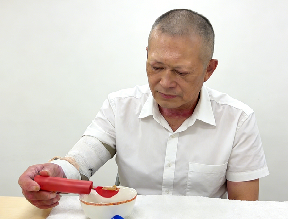 成都惠好安康烧伤康复故事：火中守护，爱中重生：一位烧伤父亲的复健之路