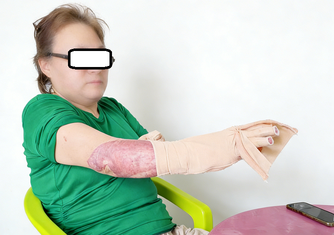 成都惠好安康烧伤康复故事：从“倚靠”到“自力”：一双灼伤的手，如何重拾生活的主权