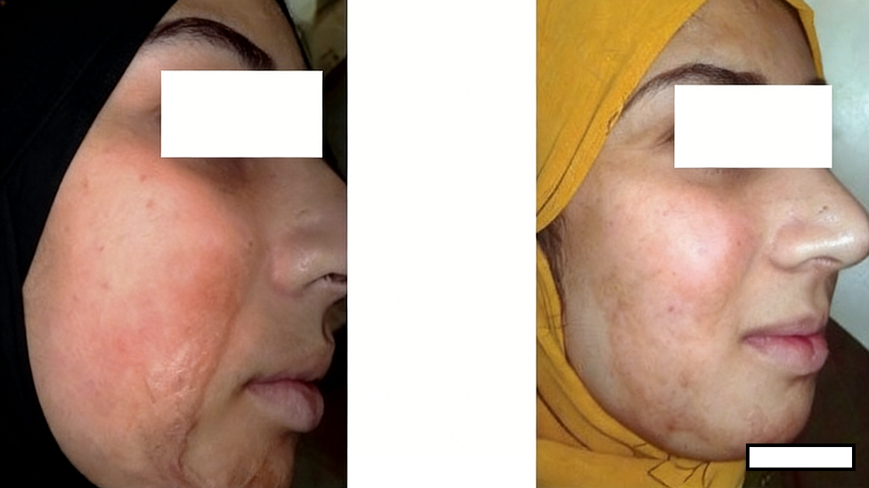 成都惠好安康烧伤康复故事：天山之痕，蓉城愈美：一位新疆女性的面部涅槃记