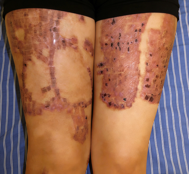 成都惠好安康烧伤康复故事：美的代价：一位成都白领的祛疤迷途与回归之旅