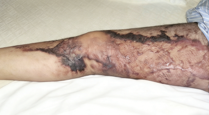 成都惠好安康烧伤康复故事：重返球场：一位成都父亲的烧伤康复之路