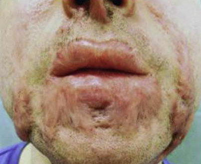 成都惠好安康烧伤康复故事：从紧闭到绽放：3D定制压力面罩与动态扩口器如何为烧伤小口症开启新生之门