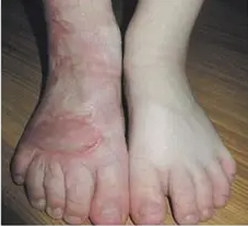 成都惠好安康烧伤康复故事：改写“铁律”：8岁男孩如何用康复对抗医学预判