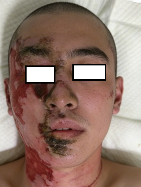 成都惠好安康烧伤康复故事 ：戈壁上的脸：一个克拉玛依男人的1.5年重生记