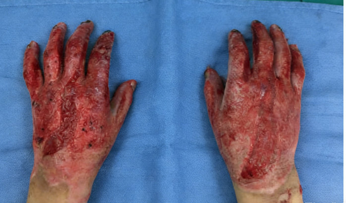 成都惠好安康烧伤康复故事：手的重生：一个34岁男人的1400个日与夜