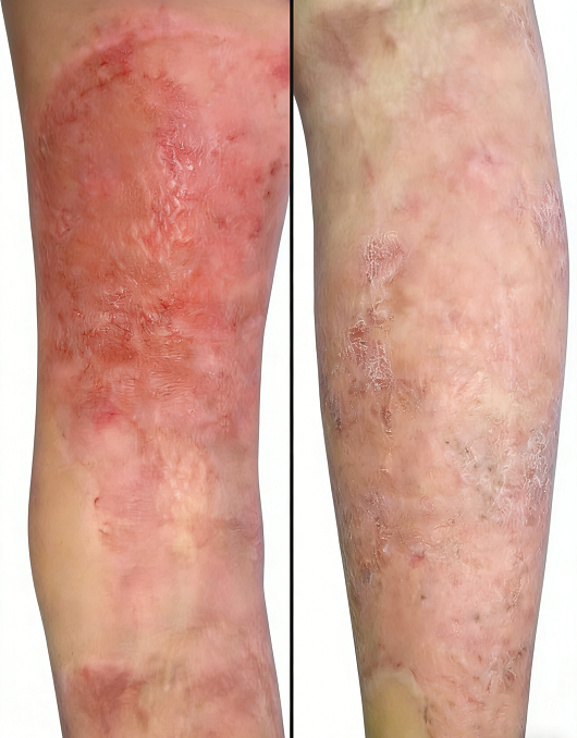 成都惠好安康烧伤康复故事：浴火重生的1000公里：一个贵州女孩的烧伤康复日记