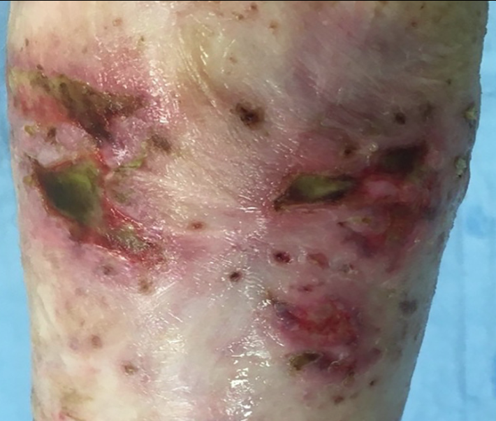 成都惠好安康烧伤康复案例故事：一锅猪油，炸伤了她50岁的手臂