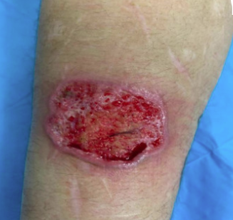 成都惠好安康烧伤康复案例故事： 那只被化学灼伤的手臂，终于能恢复如初了