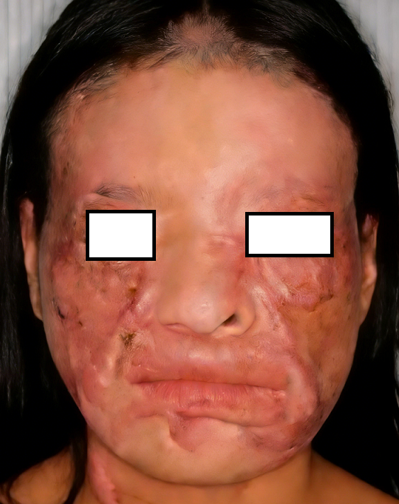 成都惠好安康烧伤康复故事：浴火芳华：一位成都女性的面容涅槃记