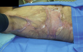 成都惠好安康烧伤康复故事：40岁那年，他终于敢脱掉衣服洗澡了