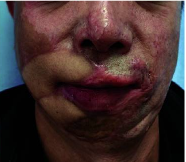 成都惠好安康烧伤康复故事：疤痕不会自己消失，但他花了2年学会了这件事