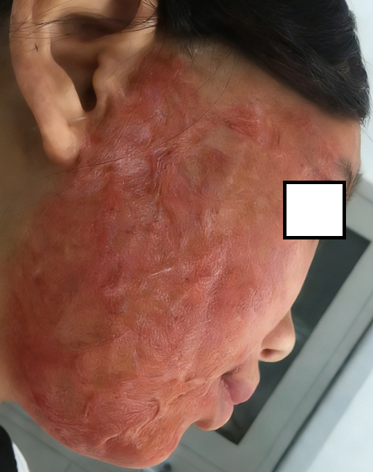 成都惠好安康烧伤康复故事： 浴火重生：一位女大学生面部燃气三度烧伤后的抗疤新生之路