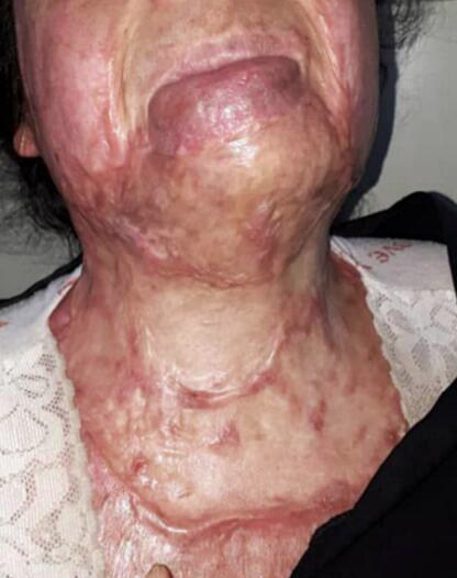 惠好安康烧伤康复故事：一位退休阿姨的重生之路：有些修复，多大年纪都不晚