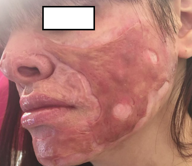 成都惠好安康烧伤康复故事：镜中人：一个平面模特的1.5年面庞重生记