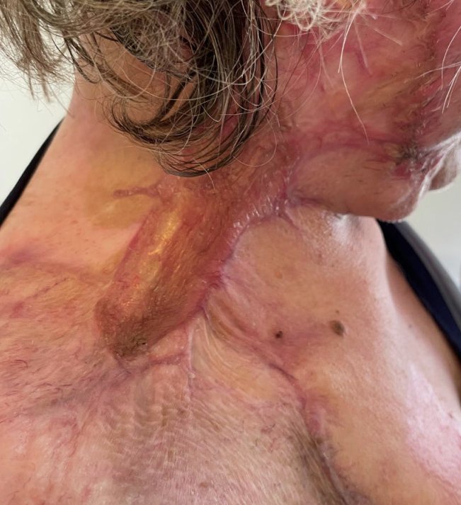 破茧重生，重启美好——成都惠好安康烧伤康复珍女士烧伤康复纪实