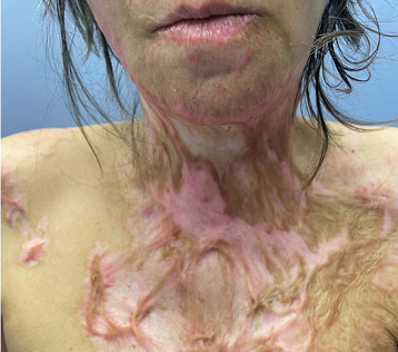 浴火重生，笑容如初——成都惠好安康烧伤康复苘女士康复纪实