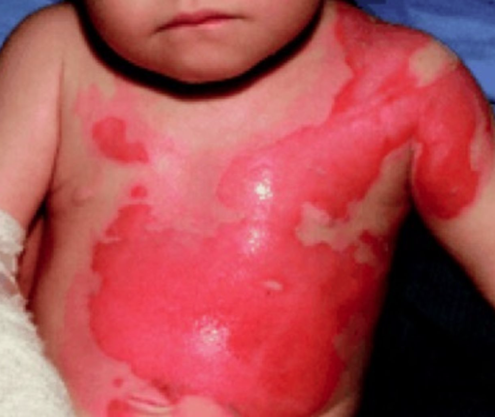 成都惠好安康烧伤康复故事：小乐乐的疤痕褪色记——从绝望到重生的545天