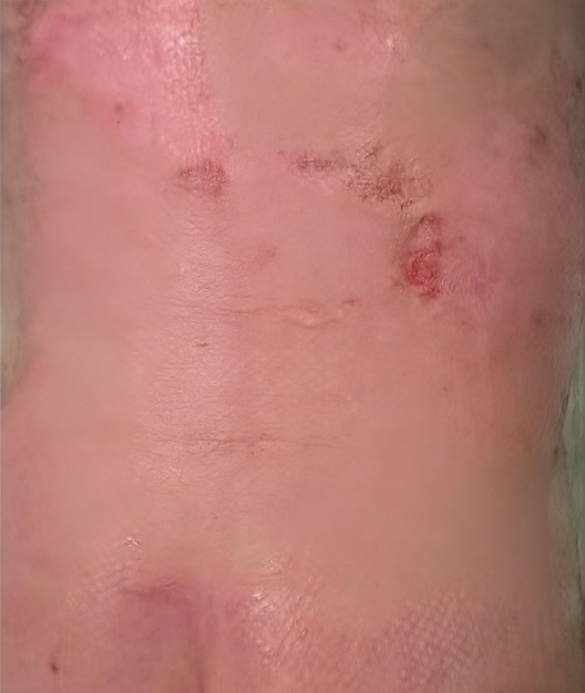 成都惠好安康烧伤康复故事：蝴蝶背上的花开：一个4岁女孩的烧伤康复之路