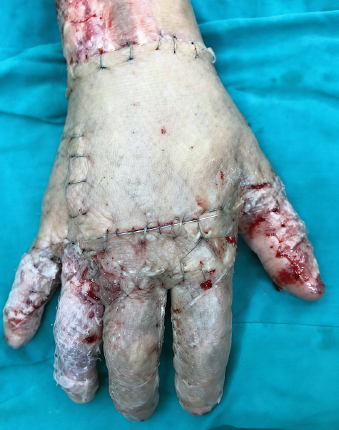 成都惠好安康烧伤康复故事：掌勺人的手：一个火锅老板的1.5年重生记