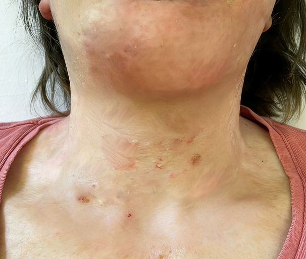 惠好安康烧伤康复故事：颈上的山河：一个野外勘探者的2年重生记