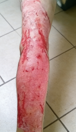 成都惠好安康烧伤康复故事：站立的代价：一个母亲的1.2年康复路