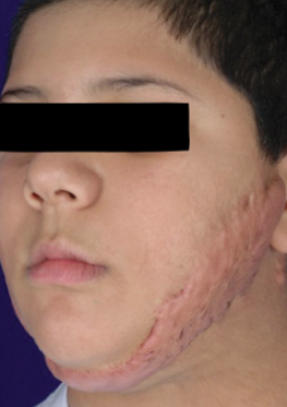 成都惠好安康烧伤康复：五年，终于等到皮肤对我说“没关系”