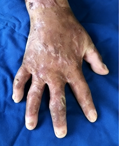 成都惠好安康烧伤康复故事：掌勺人的手：一个火锅老板的1.5年重生记