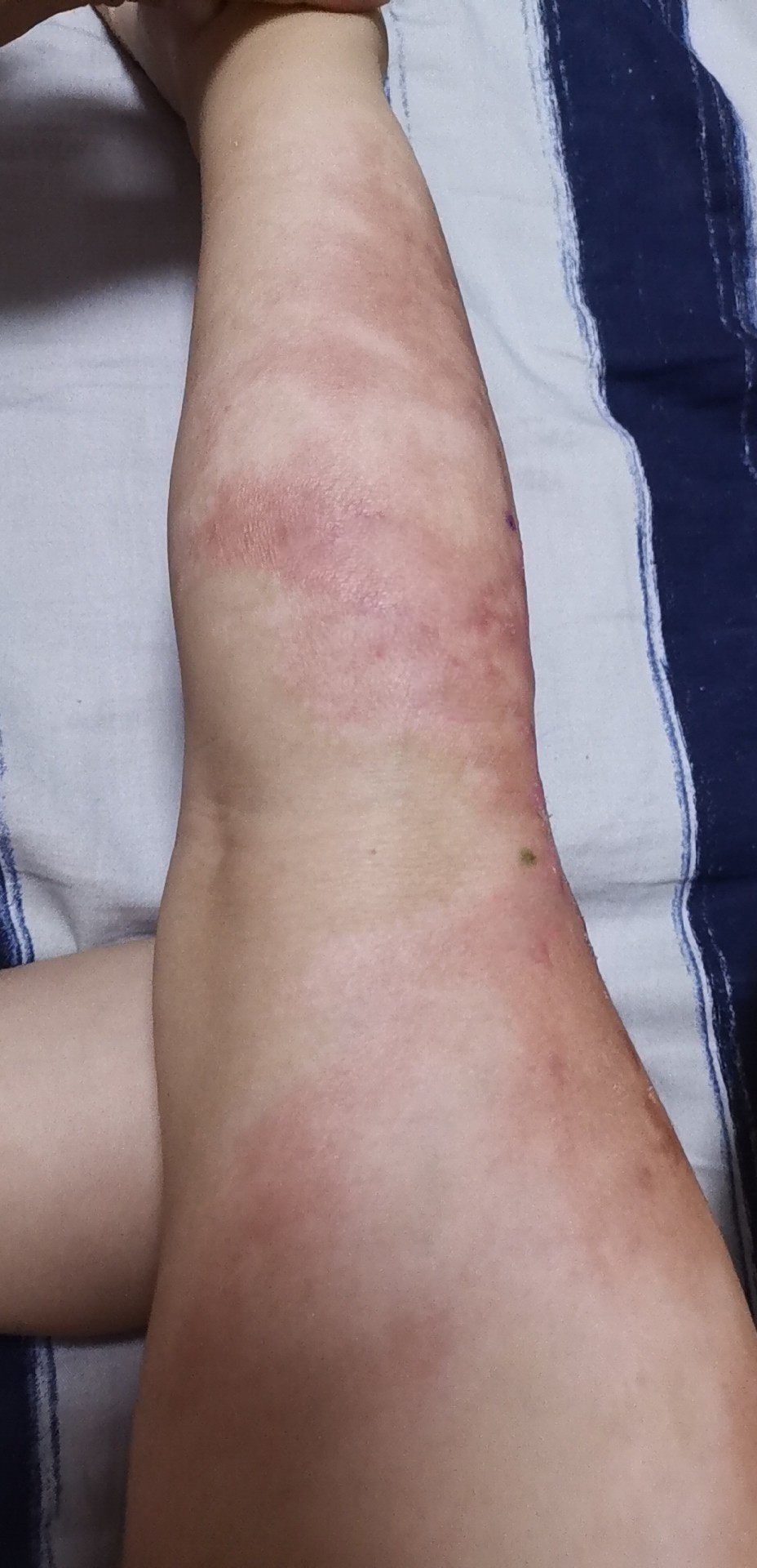 成都惠好安康烧伤康复故事：西安男孩的浴火重生：60%烧伤到奔跑如风的450天奇迹