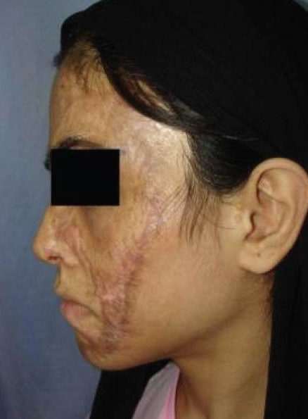 成都惠好安康烧伤康复故事：从毁容到重生：一个新疆女孩在成都的300天