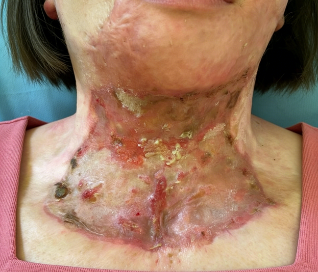 惠好安康烧伤康复故事：颈上的山河：一个野外勘探者的2年重生记