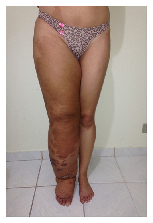 kts 弹力压力衣套定制