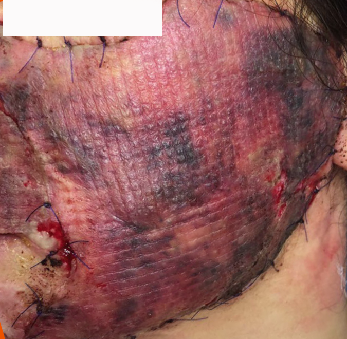 成都惠好安康烧伤康复故事：川西的脸：27岁女孩的2年面庞重生记