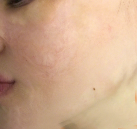 成都惠好安康烧伤康复故事：川西的脸：27岁女孩的2年面庞重生记