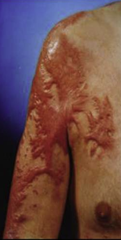 成都惠好安康烧伤康复故事：被“焊”住的手臂：45天突破腋下粘连的康复奇迹