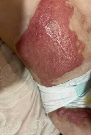 成都惠好安康烧伤康复故事：被烫伤的童年，被治愈的微笑：贵阳2岁宝宝的腹部疤痕康复之路