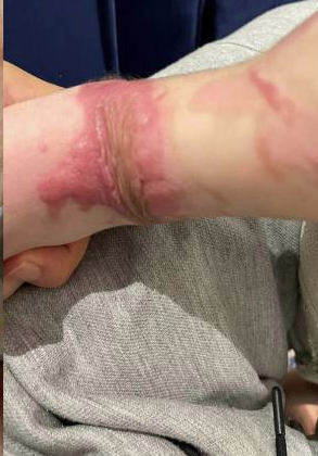 成都惠好安康烧伤康复故事：被“锁住”的小胳膊——3D定制矫形器如何让烧伤宝宝重新拥抱世界